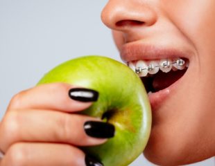 رژیم غذایی ارتودنسی