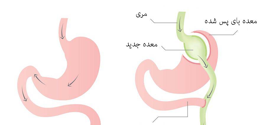 بای پس معده