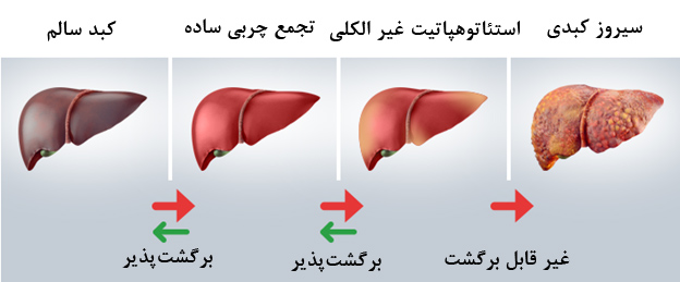 انواع کبد چرب