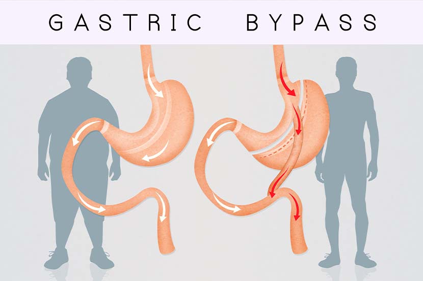 جراحی بای پس معده