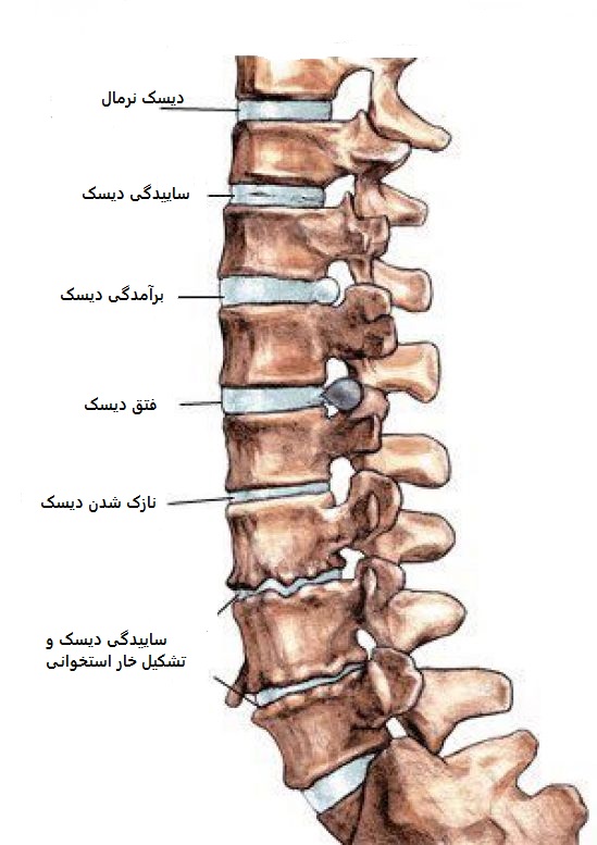 انواع دیسک کمر