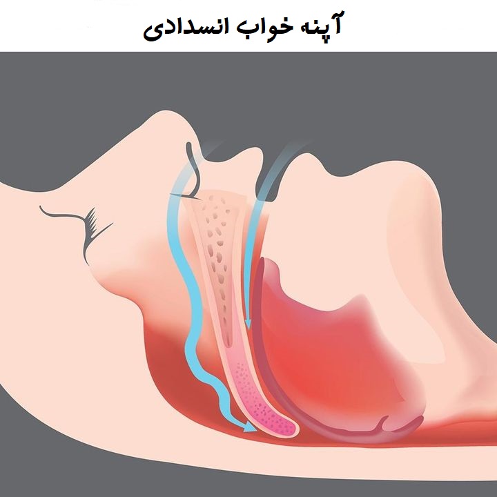 آپنه خواب انسدادی