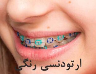ارتودنسی رنگی