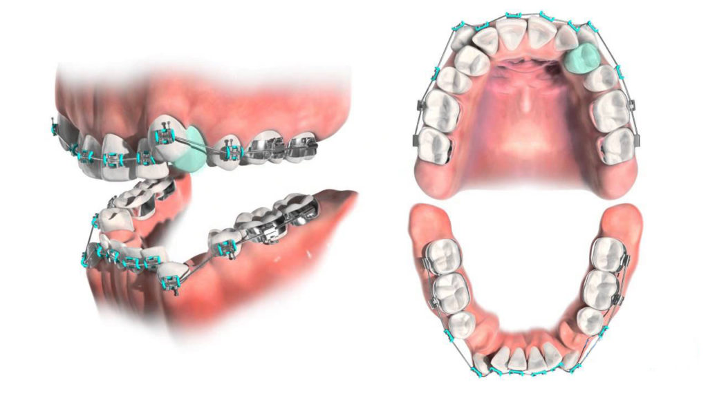 کدام دندان ها برای ارتودنسی کشیده می شوند