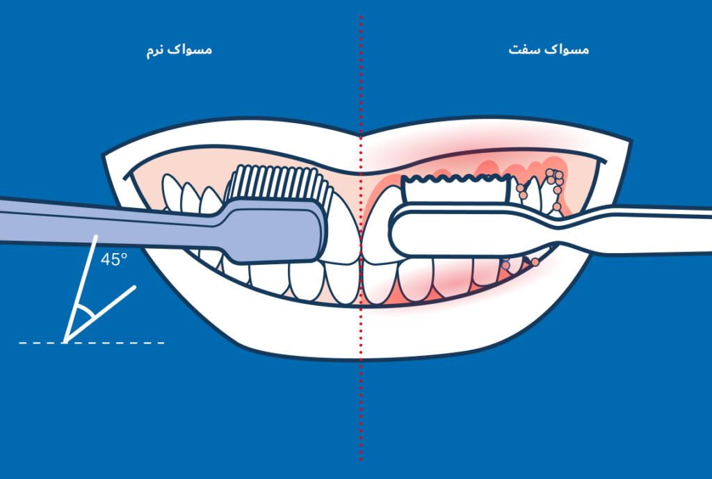 مسواک نرم در مقایسه با مسواک سفت