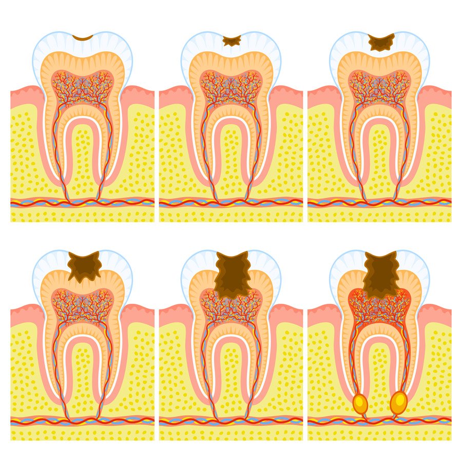 مراحل پوسیدگی دندان