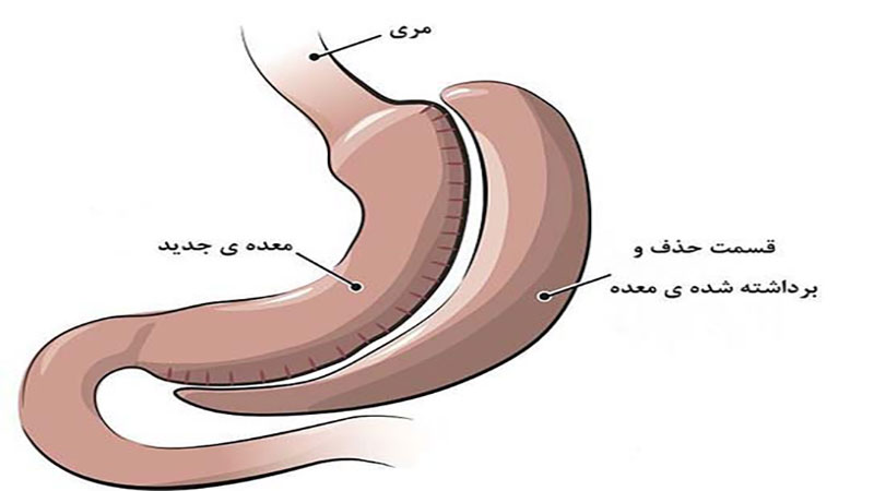 مزایای اسلیو