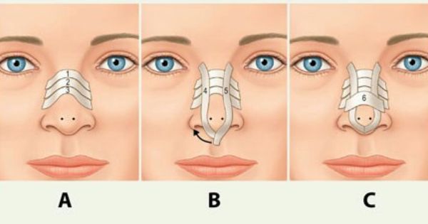 نحوه چسب زدن بعد از عمل بینی