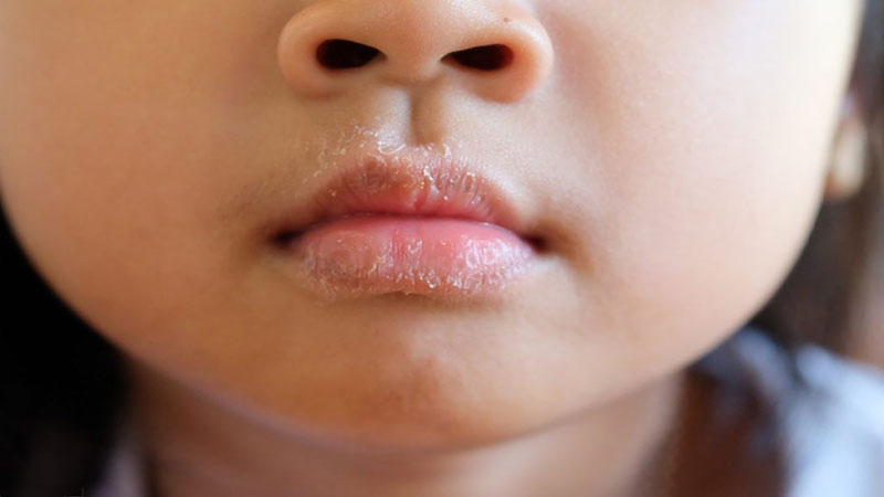علائم و نشانه‌های خشکی دهان
