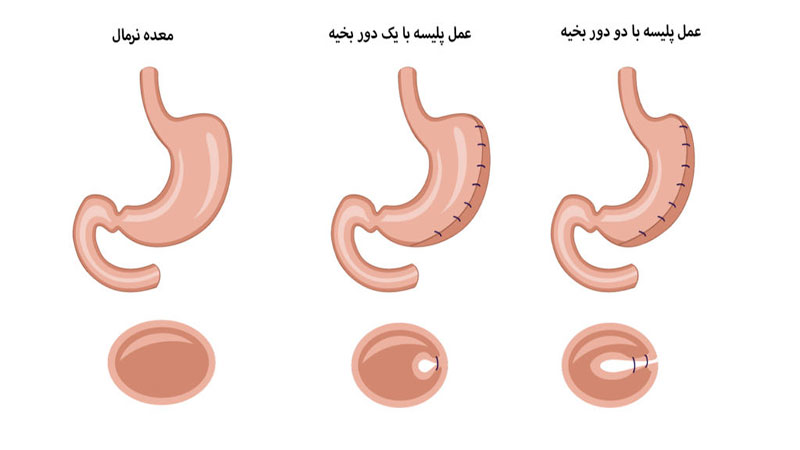 پلیسه معده