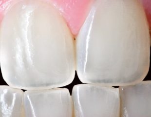 نازک شدن دندان - شیشه ای شدن دندان