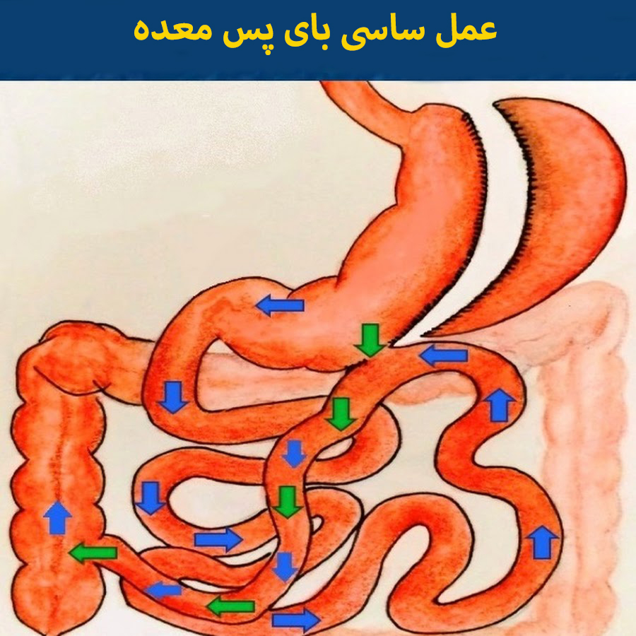 عمل ساسی بای پس معده