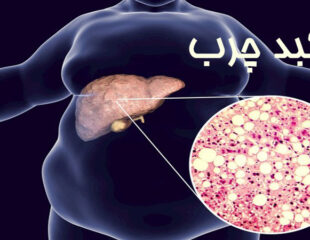 کبد چرب درمان