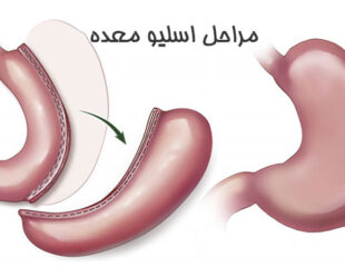 مراحل اسلیو معده