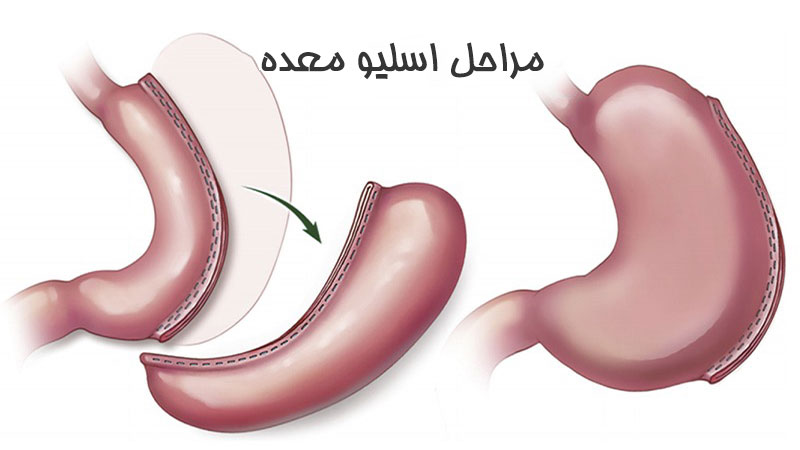 مراحل اسلیو معده