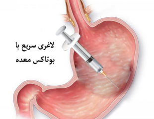 بوتاکس معده