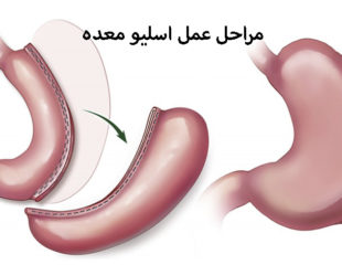 مراحل عمل اسلیو معده