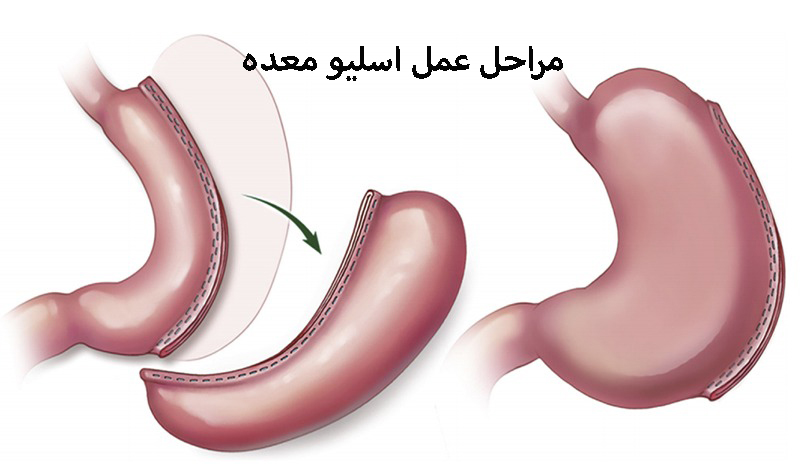مراحل عمل اسلیو معده