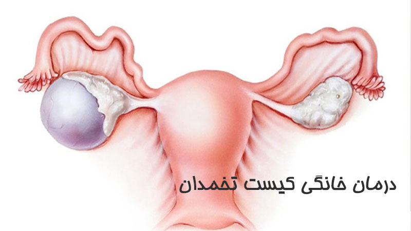 درمان خانگی کیست تخمدان