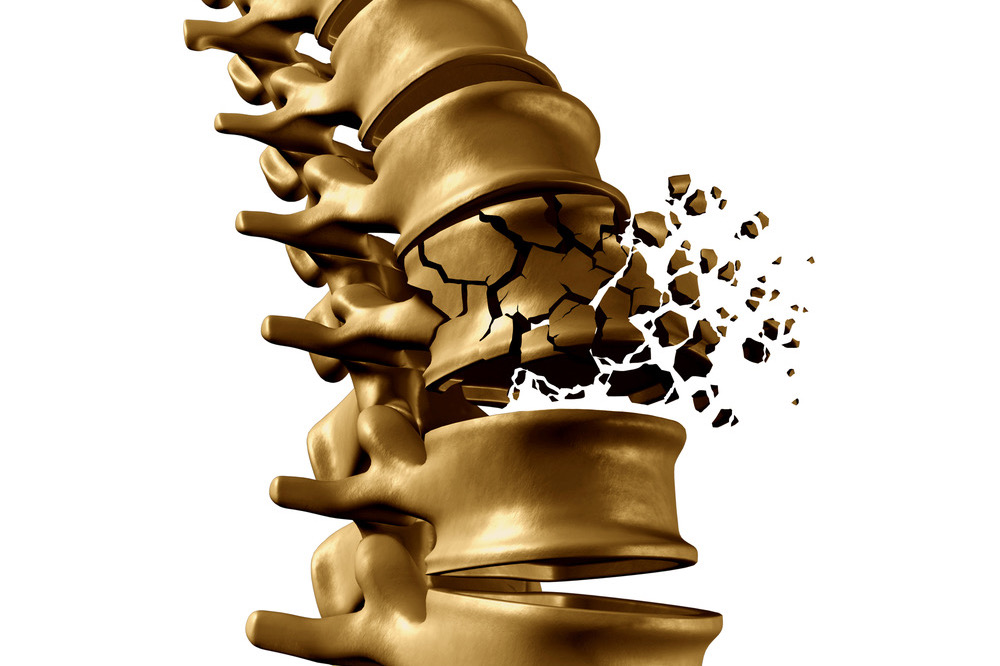 ترک و شکستگی مهره کمر