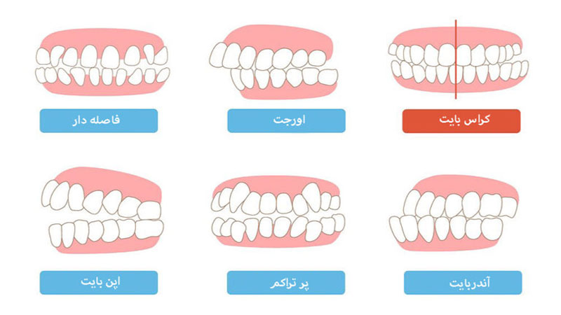 ناهنجاری های دندانی
