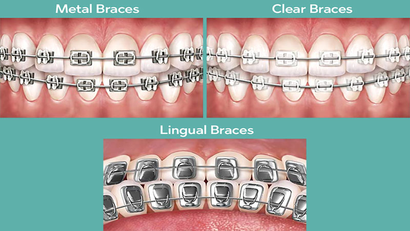 انواع ارتودنسی ثابت
