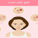 انواع جوش صورت