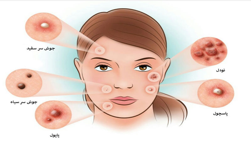 درمان انواع جوش صورت
