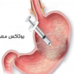 بوتاکس معده