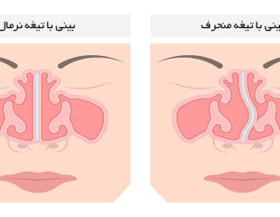 درمان انحراف بینی بدون عمل