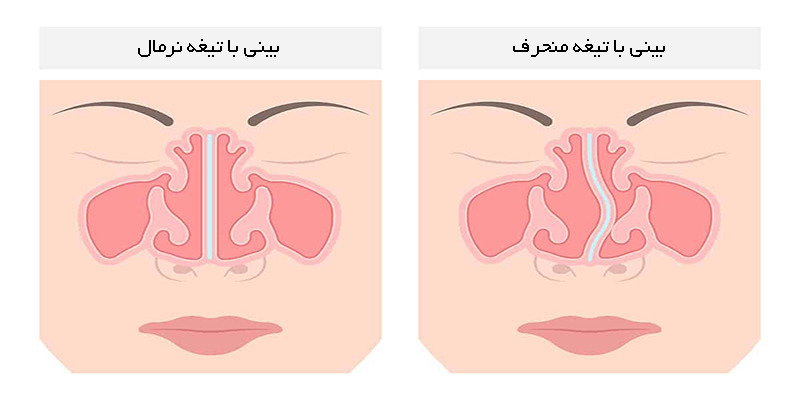 درمان انحراف بینی بدون عمل