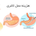 هزینه عمل لاغری
