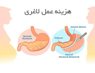 هزینه عمل لاغری