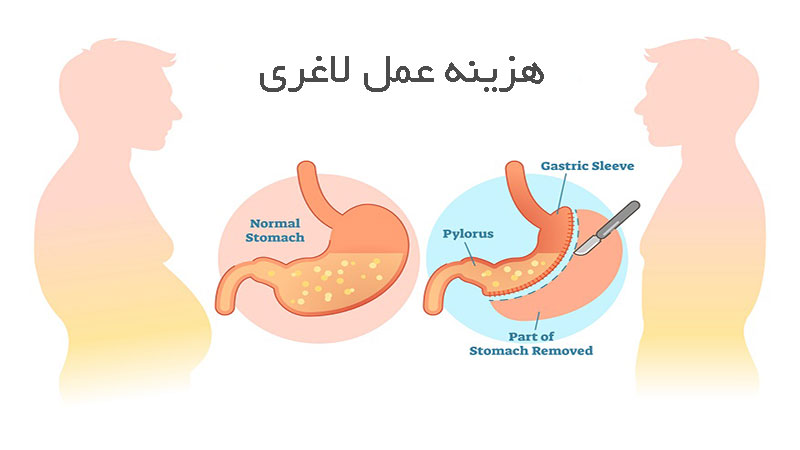 هزینه عمل لاغری