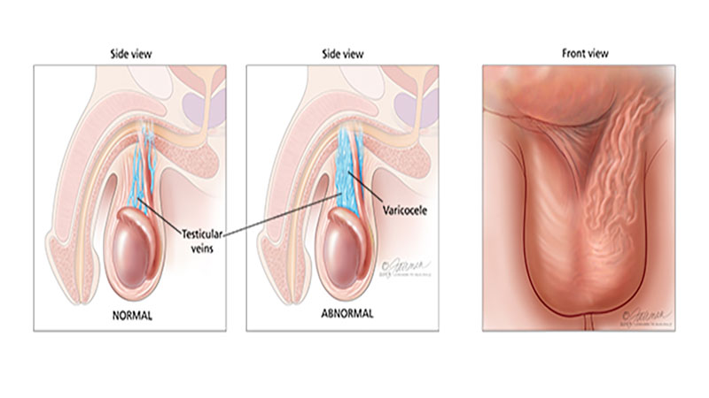 واریکوسل بیضه