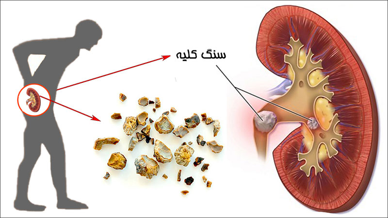 سنگ کلیه