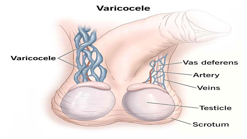 واریکوسل بیضه چیست