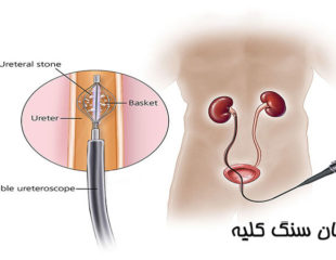 درمان سنگ کلیه