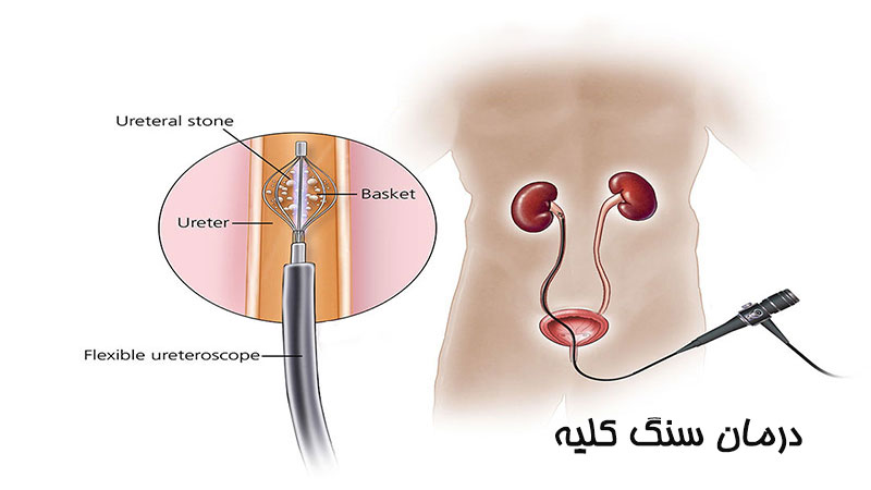درمان سنگ کلیه