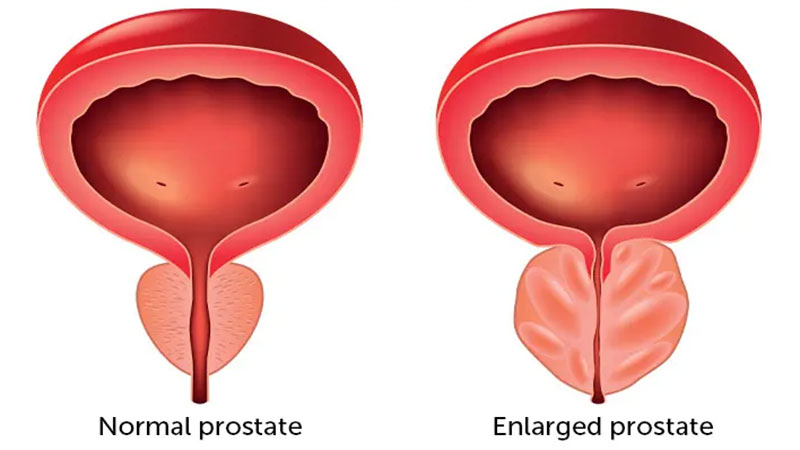 بیماری های پروستات