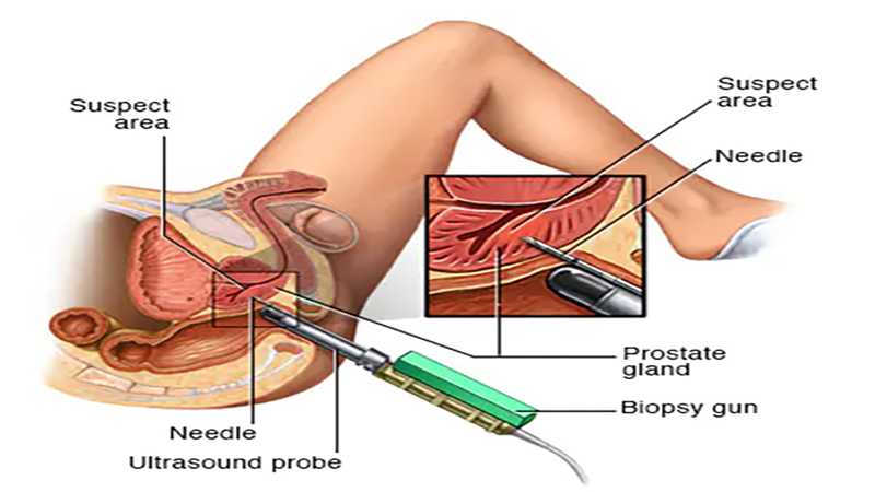 انجام جراحی پروستات