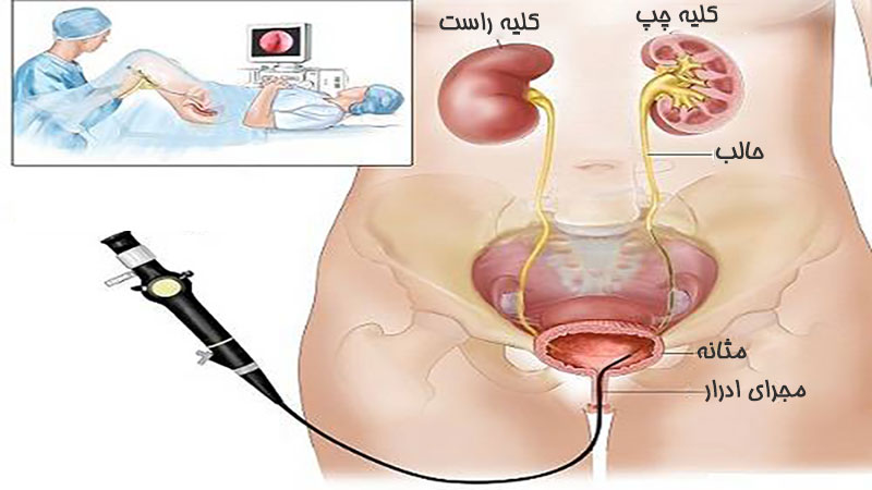 جراحی سنگ کلیه