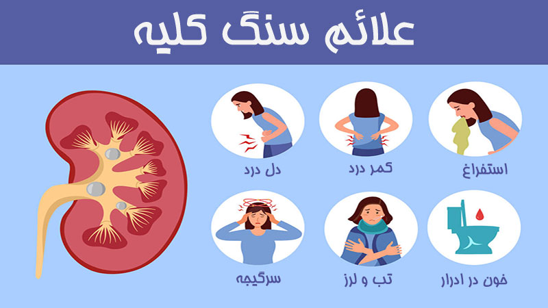 علائم سنگ کلیه