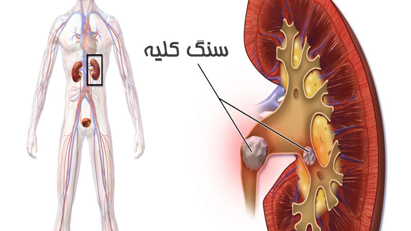سنگ کلیه