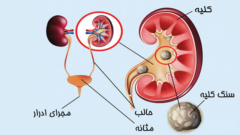 سنگ کلیه چیست