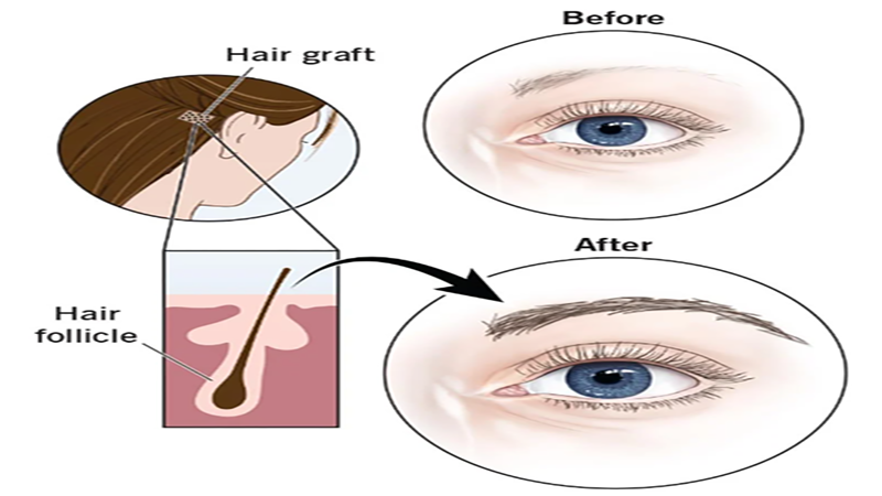 فرم ابرو و میزان گرافت های مورد نیاز