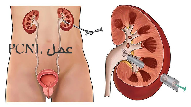 عمل PCNL