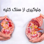 جلوگیری از سنگ کلیه