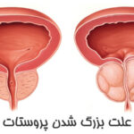 علت بزرگ شدن پروستات