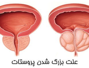 علت بزرگ شدن پروستات